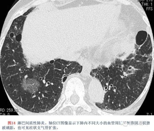 特发性间质性肺炎的分类:自2002年以来知识新进展 特发性间质性肺炎的分类:自2002年以来知识新进展