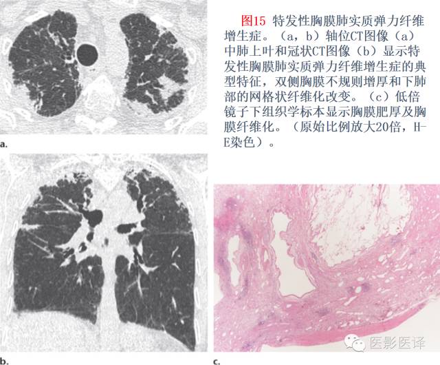 特发性间质性肺炎的分类:自2002年以来知识新进展 特发性间质性肺炎的分类:自2002年以来知识新进展