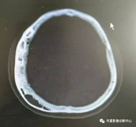 这样的颅骨骨瘤，你见过吗？