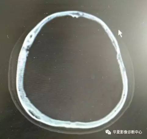 这样的颅骨骨瘤，你见过吗？