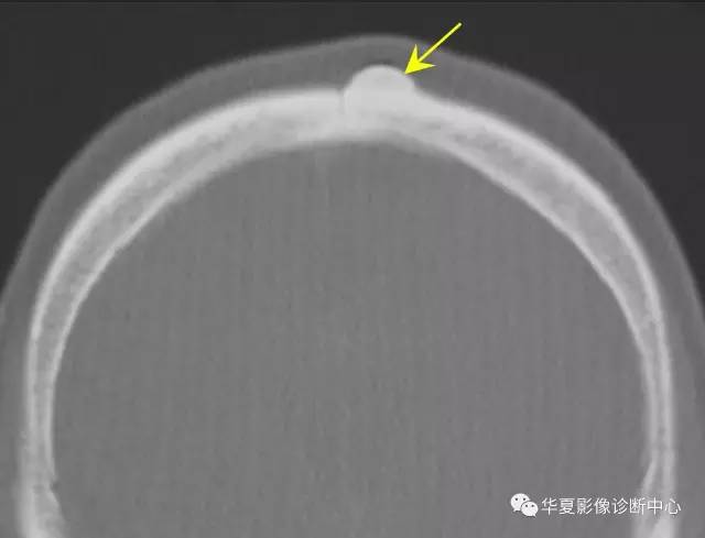 这样的颅骨骨瘤，你见过吗？