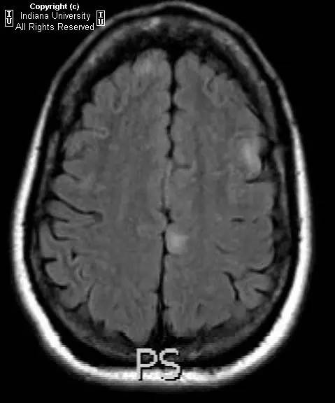 【病例】结节性硬化症(脑,肺,肾脏异常)一例CT及MR影像表现 【病例】结节性硬化症(脑,肺,肾脏异常)一例CT及MR影像表现