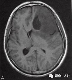 【病例】胶质母细胞瘤1例MR影像表现 【病例】胶质母细胞瘤1例MR影像表现