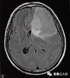 【病例】胶质母细胞瘤1例MR影像表现 【病例】胶质母细胞瘤1例MR影像表现