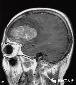 【病例】胶质母细胞瘤1例MR影像表现 【病例】胶质母细胞瘤1例MR影像表现