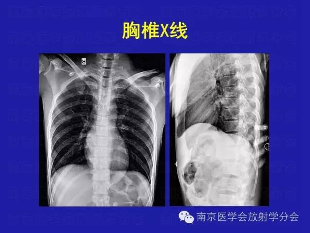 【病例】脊柱骨肉瘤1例CT及MR