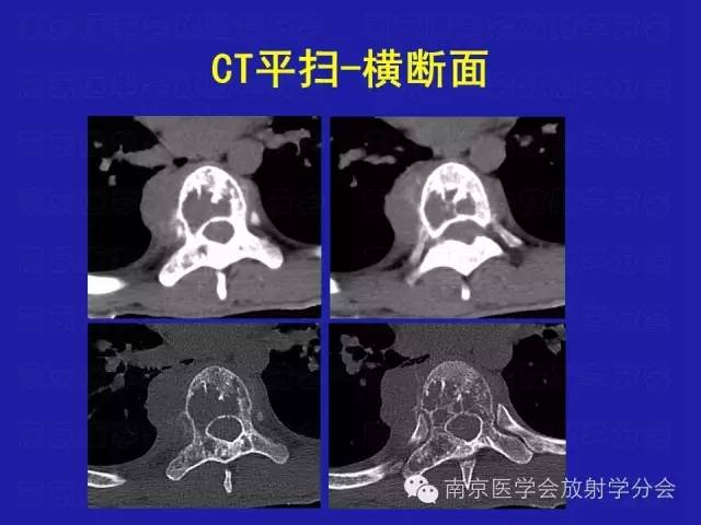 【病例】脊柱骨肉瘤1例CT及MR