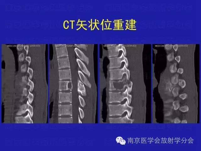 【病例】脊柱骨肉瘤1例CT及MR