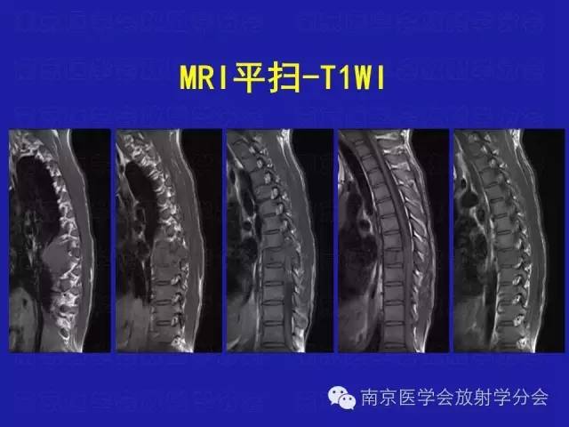 【病例】脊柱骨肉瘤1例CT及MR