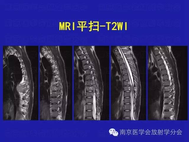 【病例】脊柱骨肉瘤1例CT及MR