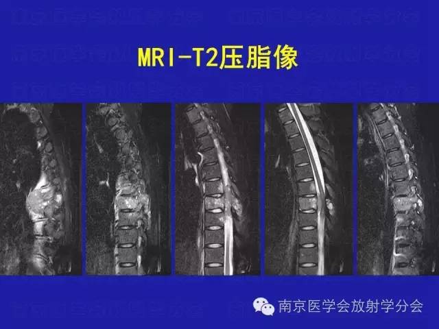 【病例】脊柱骨肉瘤1例CT及MR