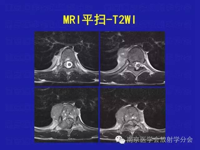 【病例】脊柱骨肉瘤1例CT及MR