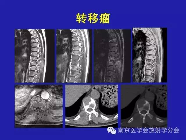 【病例】脊柱骨肉瘤1例CT及MR