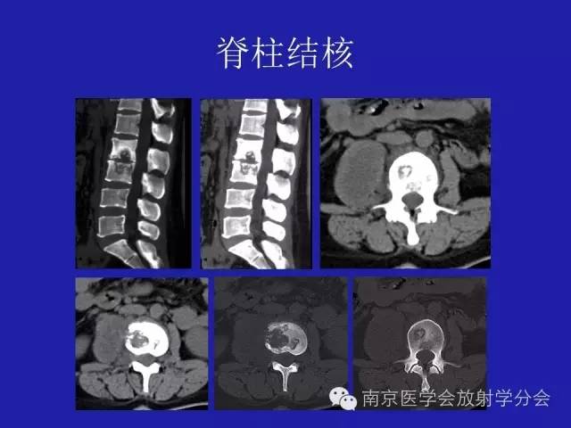 【病例】脊柱骨肉瘤1例CT及MR