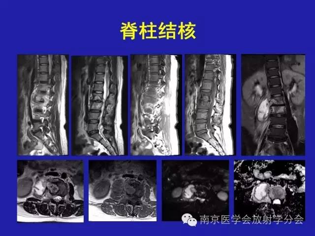 【病例】脊柱骨肉瘤1例CT及MR