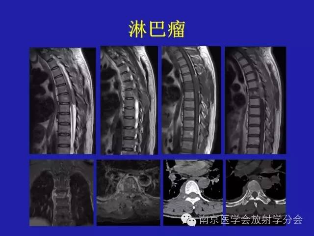 【病例】脊柱骨肉瘤1例CT及MR
