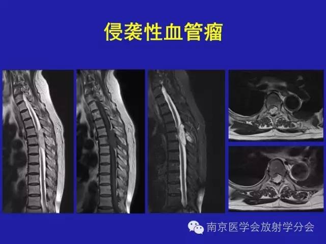 【病例】脊柱骨肉瘤1例CT及MR