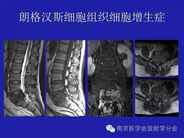 【病例】脊柱骨肉瘤1例CT及MR