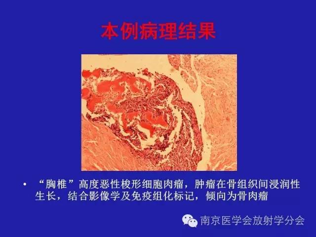 【病例】脊柱骨肉瘤1例CT及MR