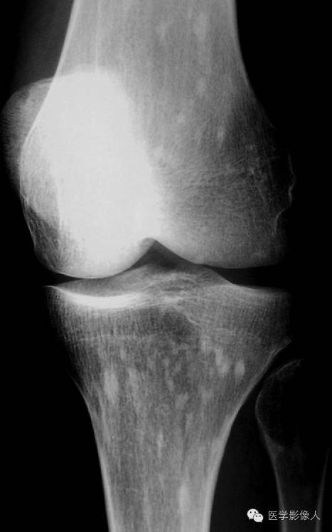 15种累及骨骼与皮肤综合征 15种累及骨骼与皮肤综合征