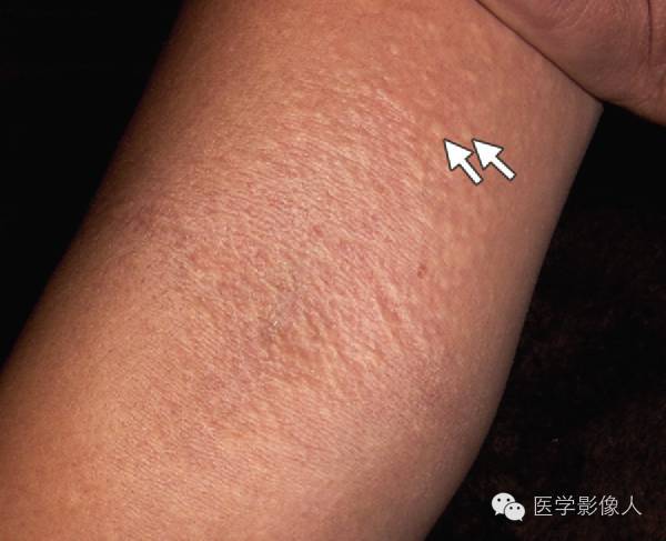 15种累及骨骼与皮肤综合征 15种累及骨骼与皮肤综合征
