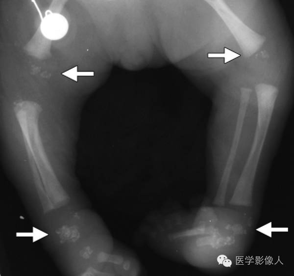 15种累及骨骼与皮肤综合征