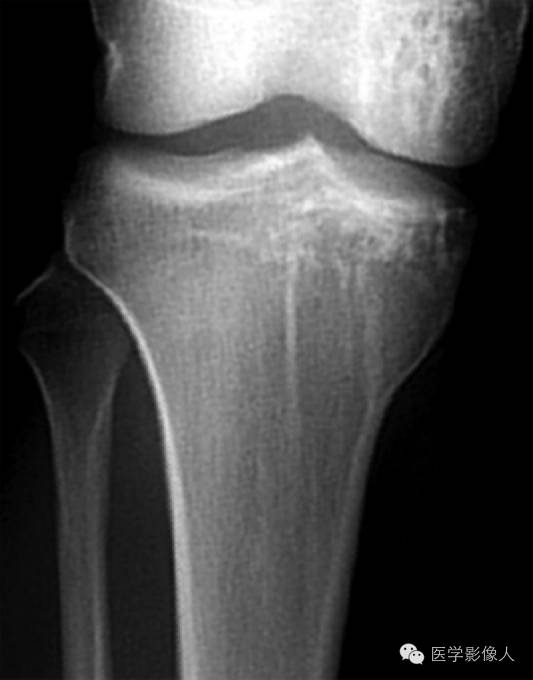 15种累及骨骼与皮肤综合征 15种累及骨骼与皮肤综合征