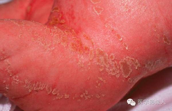 15种累及骨骼与皮肤综合征 15种累及骨骼与皮肤综合征