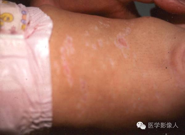 15种累及骨骼与皮肤综合征 15种累及骨骼与皮肤综合征