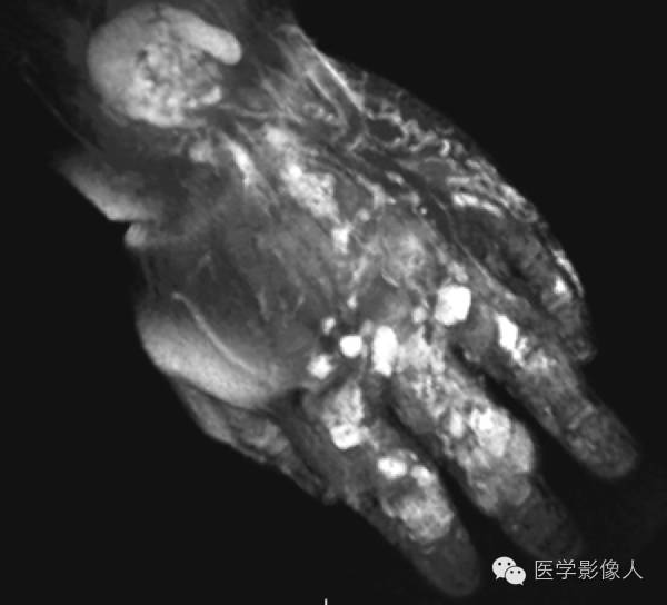 15种累及骨骼与皮肤综合征 15种累及骨骼与皮肤综合征