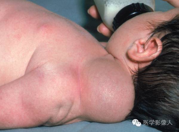 15种累及骨骼与皮肤综合征 15种累及骨骼与皮肤综合征