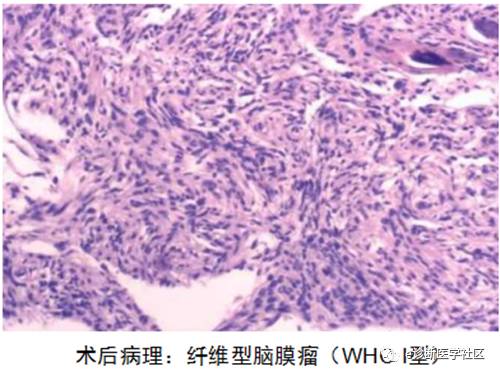 15种亚型脑膜瘤影像表现及诊断要点 15种亚型脑膜瘤影像表现及诊断要点
