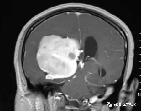 15种亚型脑膜瘤影像表现及诊断要点 15种亚型脑膜瘤影像表现及诊断要点