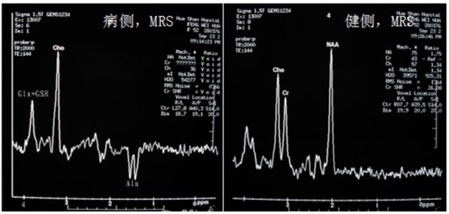15种亚型脑膜瘤影像表现及诊断要点 15种亚型脑膜瘤影像表现及诊断要点
