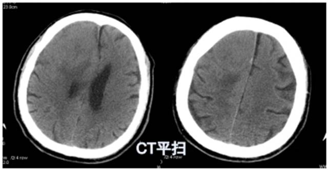 15种亚型脑膜瘤影像表现及诊断要点 15种亚型脑膜瘤影像表现及诊断要点
