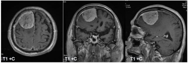 15种亚型脑膜瘤影像表现及诊断要点 15种亚型脑膜瘤影像表现及诊断要点