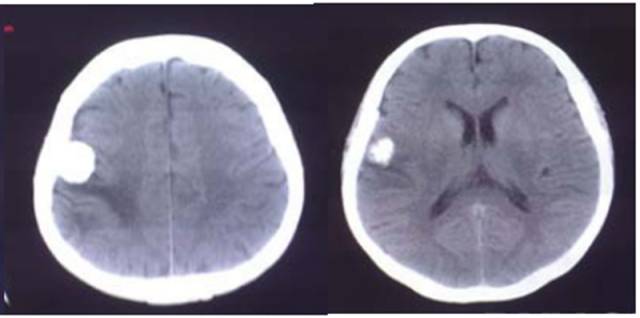 15种亚型脑膜瘤影像表现及诊断要点 15种亚型脑膜瘤影像表现及诊断要点