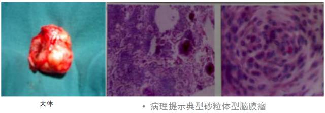 15种亚型脑膜瘤影像表现及诊断要点 15种亚型脑膜瘤影像表现及诊断要点