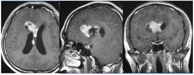 15种亚型脑膜瘤影像表现及诊断要点 15种亚型脑膜瘤影像表现及诊断要点