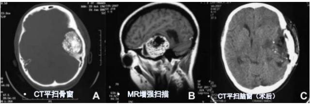 15种亚型脑膜瘤影像表现及诊断要点 15种亚型脑膜瘤影像表现及诊断要点