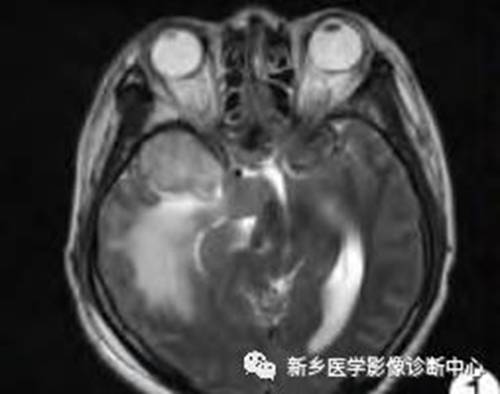 15种亚型脑膜瘤影像表现及诊断要点 15种亚型脑膜瘤影像表现及诊断要点