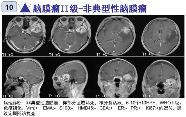 15种亚型脑膜瘤影像表现及诊断要点 15种亚型脑膜瘤影像表现及诊断要点