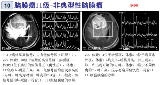 15种亚型脑膜瘤影像表现及诊断要点 15种亚型脑膜瘤影像表现及诊断要点