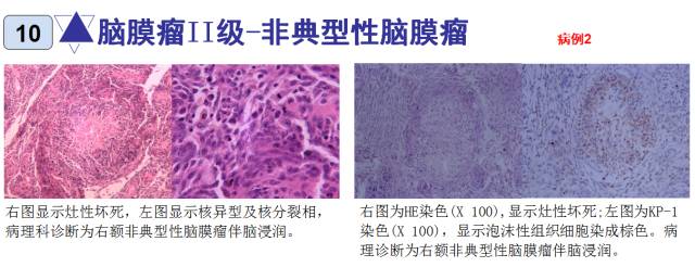 15种亚型脑膜瘤影像表现及诊断要点 15种亚型脑膜瘤影像表现及诊断要点