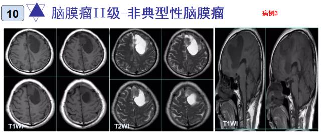 15种亚型脑膜瘤影像表现及诊断要点 15种亚型脑膜瘤影像表现及诊断要点