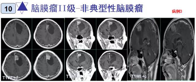 15种亚型脑膜瘤影像表现及诊断要点 15种亚型脑膜瘤影像表现及诊断要点