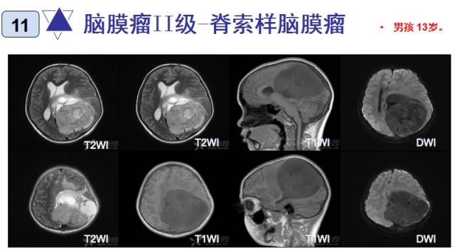 15种亚型脑膜瘤影像表现及诊断要点 15种亚型脑膜瘤影像表现及诊断要点