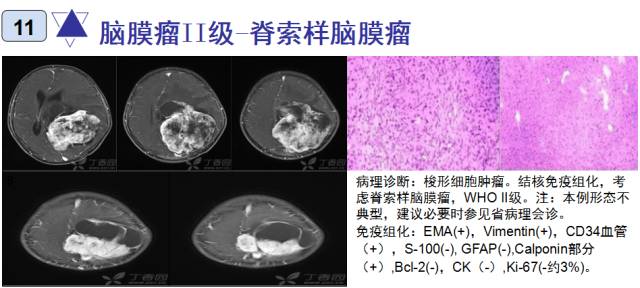 15种亚型脑膜瘤影像表现及诊断要点 15种亚型脑膜瘤影像表现及诊断要点