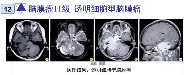 15种亚型脑膜瘤影像表现及诊断要点 15种亚型脑膜瘤影像表现及诊断要点