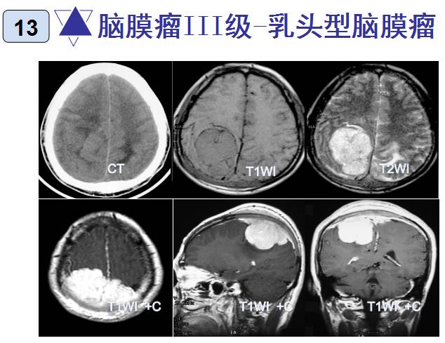 15种亚型脑膜瘤影像表现及诊断要点 15种亚型脑膜瘤影像表现及诊断要点